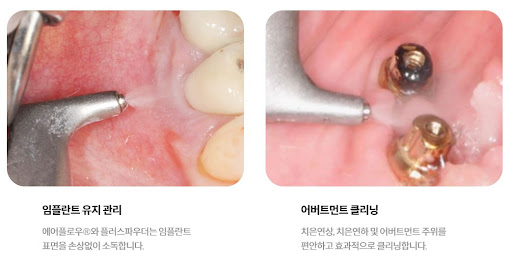 임플란트와 치아교정 전문 불당본점 서울비디치과의원에서의 탁월한 치료 안내